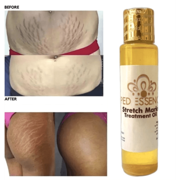 PedEssence - Stretch Marks Treatment Oil - Image 12
