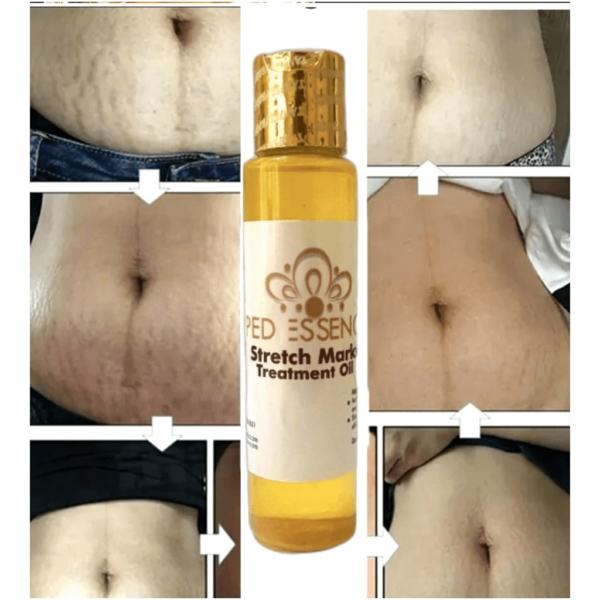 PedEssence - Stretch Marks Treatment Oil - Image 13
