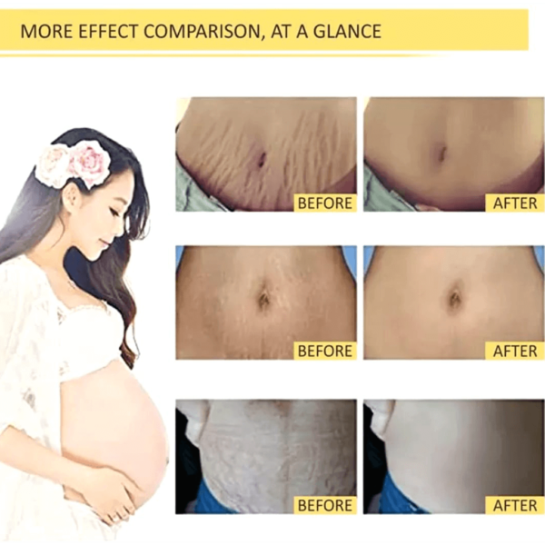 PedEssence - Stretch Marks Treatment Oil - Image 9