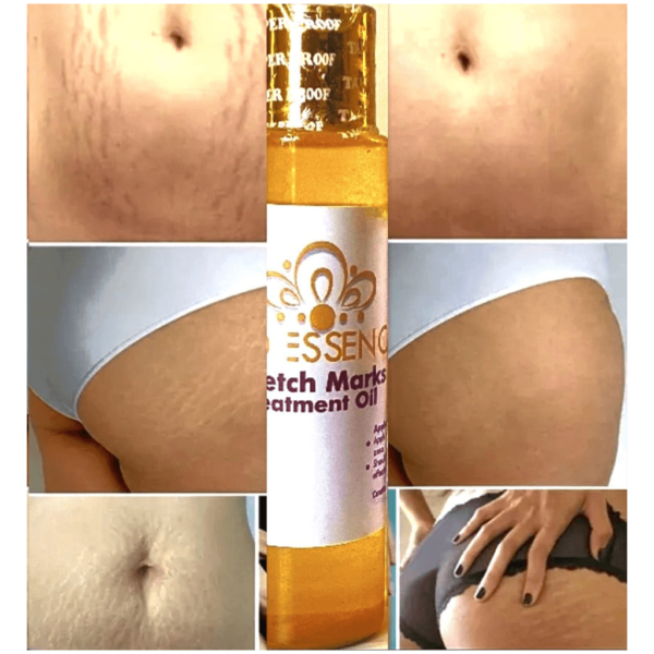 PedEssence - Stretch Marks Treatment Oil - Image 10