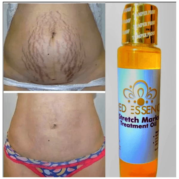 PedEssence - Stretch Marks Treatment Oil - Image 11